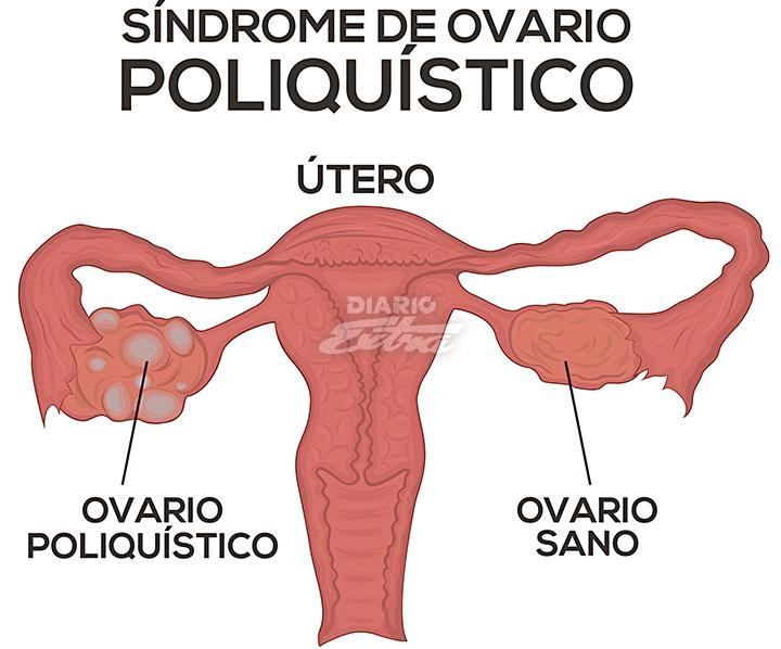 Alimentacion ovario poliquistico
